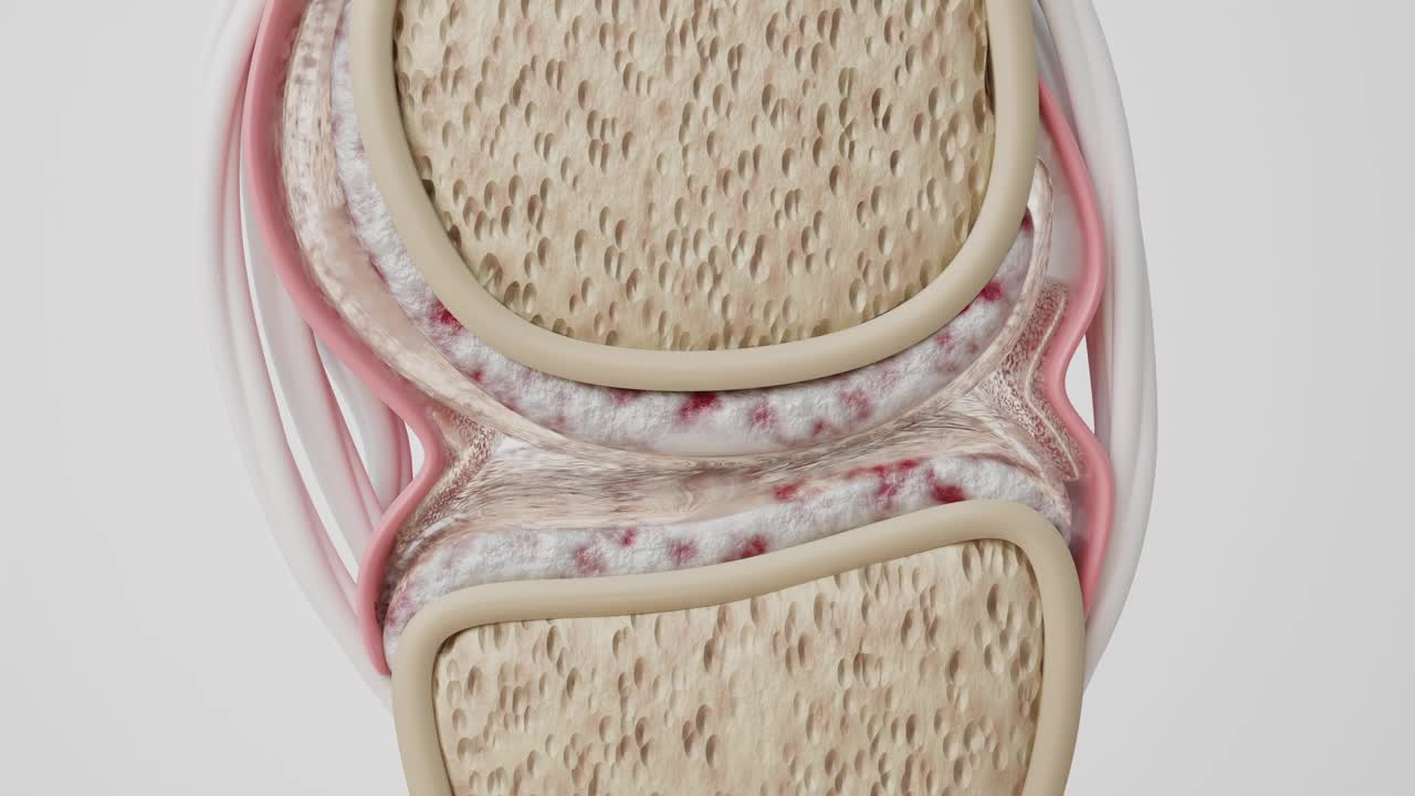 钙和膝关节涂料视频素材