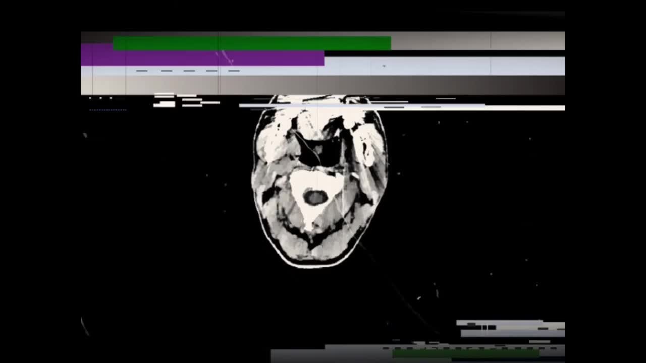 脑部CT，轴向视图，有小故障和划痕视频下载