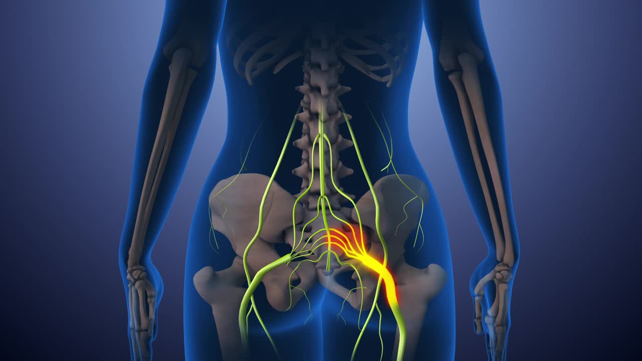 坐骨神经痛下背部从臀部到腿部视频素材