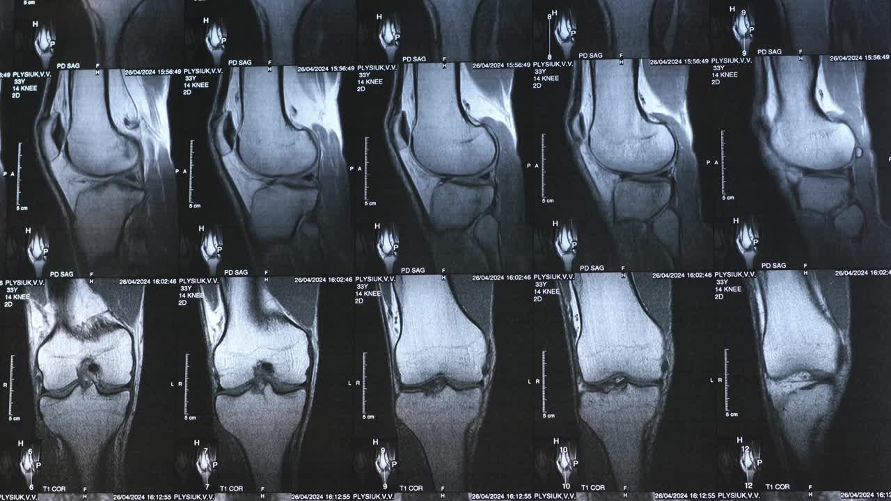 医生检查骨膝关节肿瘤。病灶周围有明显硬化的x线、MRI、MRT、CT。医疗理念。诊断人类骨骼疾病。视频素材