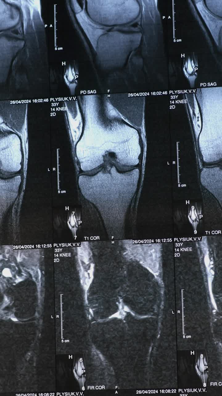 骨膝关节肿瘤的垂直影像。病灶周围有明显硬化的x线、MRI、MRT、CT。医疗理念。诊断人类骨骼疾病。视频素材