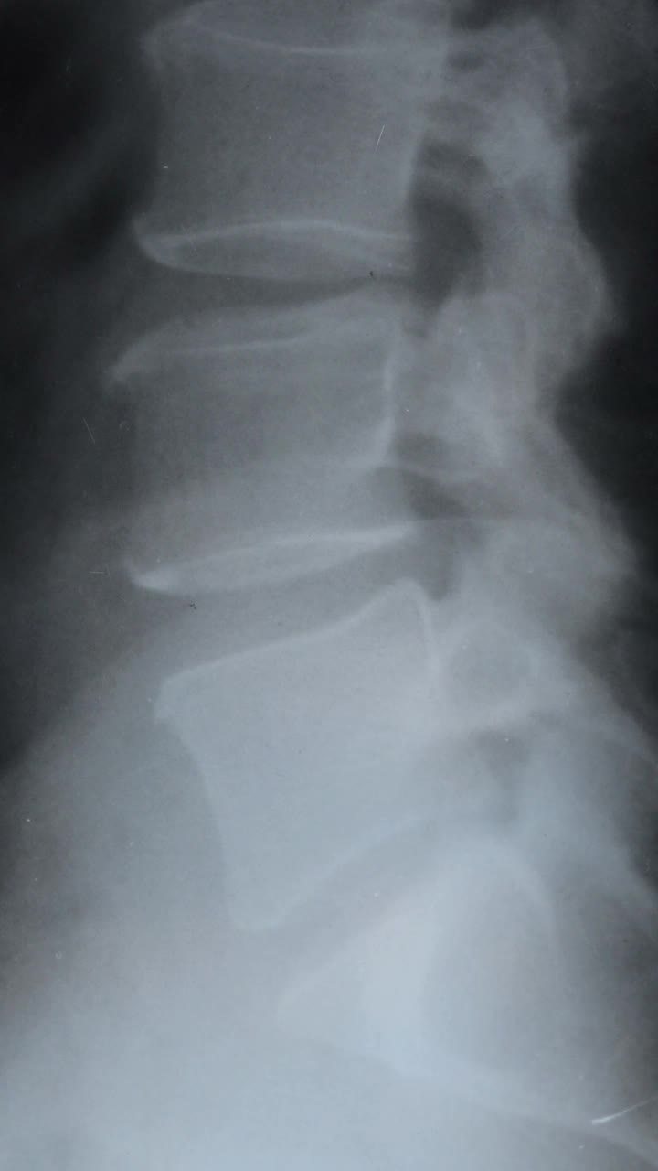 垂直影像诊断的疾病脊柱，髋关节和椎间疝。视频下载