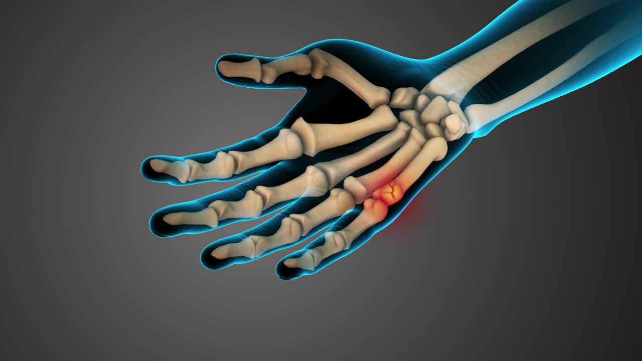 手掌骨骨折解剖学视频素材