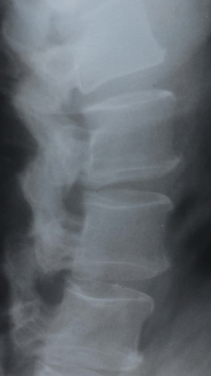 医生的垂直影像是诊断脊柱、髋关节和椎间疝的疾病。医疗理念。视频素材