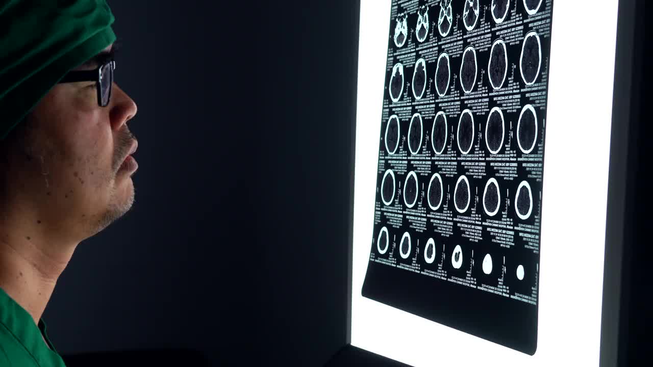 医生通过核磁共振扫描对人脑进行分析视频素材