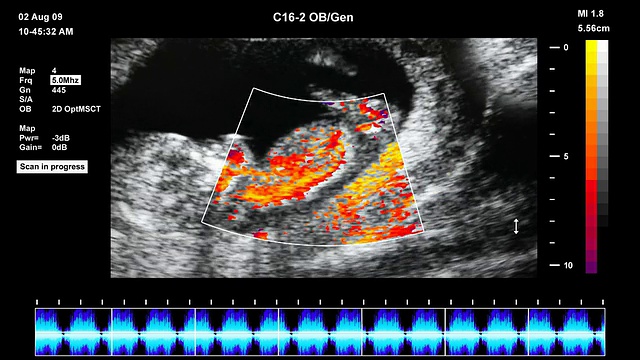 胎儿超声扫描视频素材