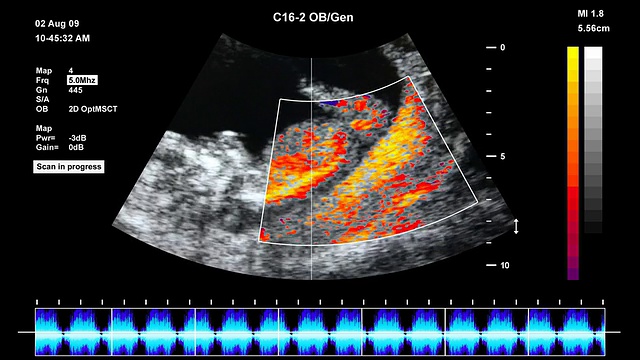 胎儿超声扫描视频购买