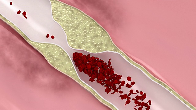 冠状动脉粥样硬化疾病视频素材