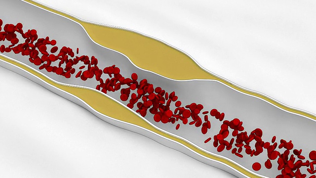 冠状动脉粥样硬化-脂肪细胞阻塞血液流动视频素材