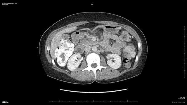 腹部CAT扫描视频素材