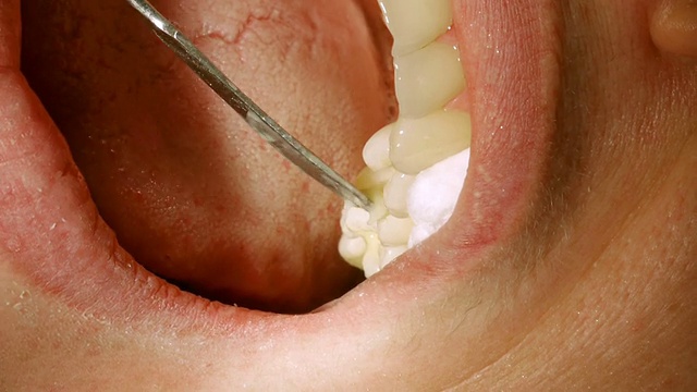 牙科医生应用嵌体水泥种植视频素材