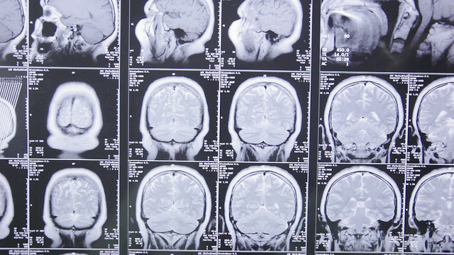 医学研究。计算机断层扫描。视频素材