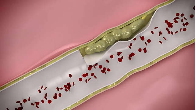 冠状动脉栓子通过循环系统视频素材