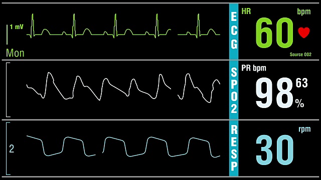 病人监视器显示医学检查的生命体征视频素材