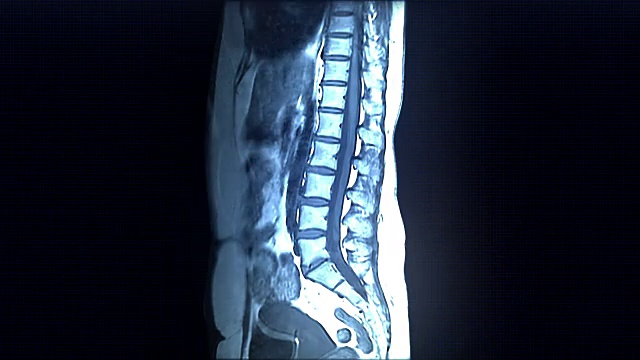 脊柱MRI扫描视频素材