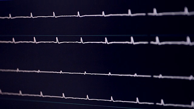 真正的心电图。在一家心脏病医院做心电图视频素材