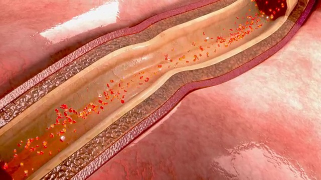冠状动脉痉挛视频素材