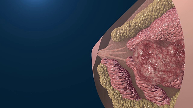 乳腺癌细胞生长动画。视频素材