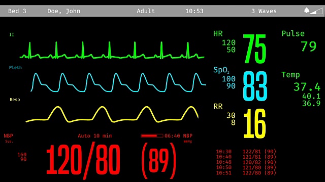 在ICU监护下监测患者病情、生命体征视频素材