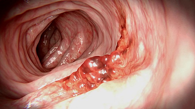 从息肉变成结直肠癌视频素材