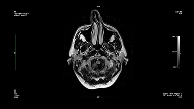 颅骨上视图-磁共振成像视频素材