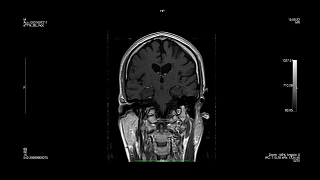 颅骨背面磁共振成像视频素材
