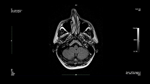 头颅向下看-磁共振成像视频素材