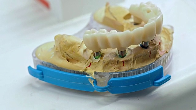 牙科技术员正在研究整体氧化锆。视频下载