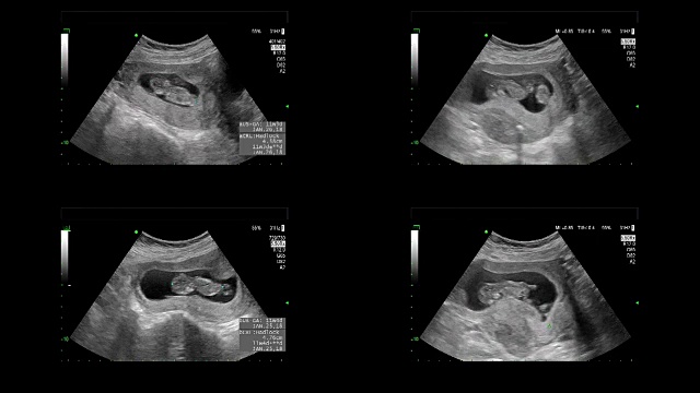 超音波显示同卵双胞胎的心脏在11周时跳动视频素材