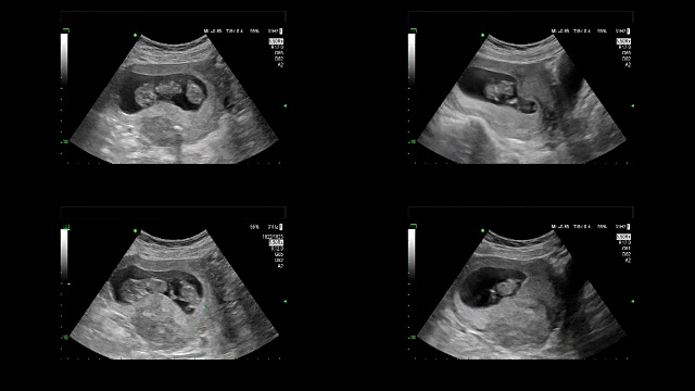 超音波显示同卵双胞胎的心脏在11周时跳动视频素材