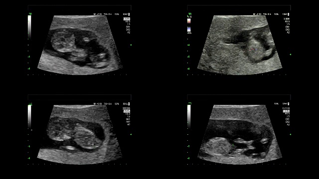 超音波显示同卵双胞胎的心脏在11周时跳动视频素材