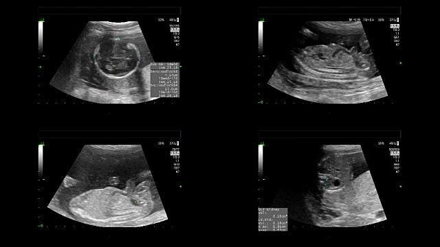 超声显示同卵双胞胎18周时心脏跳动视频素材