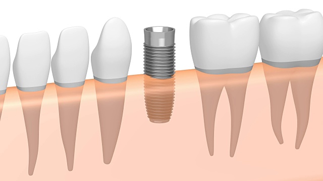 3D种植牙/种植牙视频素材