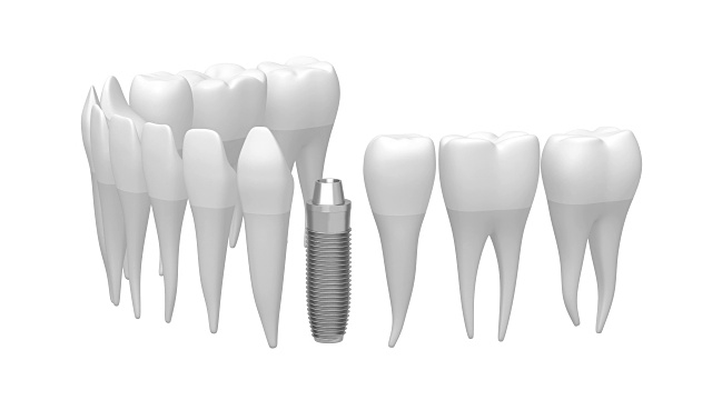3D种植牙/种植牙视频素材