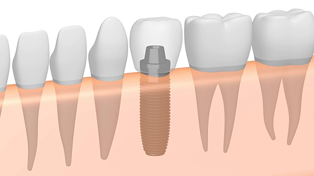 3D龋齿/植牙视频素材