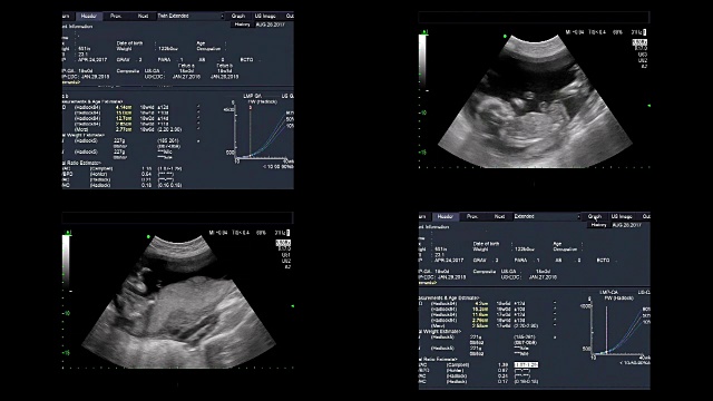 超声显示同卵双胞胎18周时心脏跳动视频素材