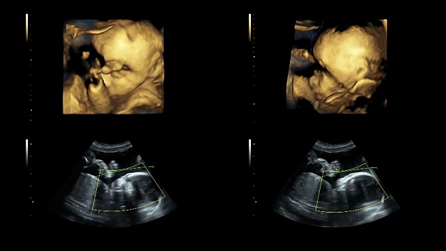 超音波显示25周时同卵双胞胎的心跳视频素材