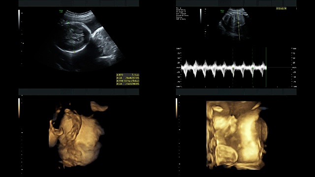 超音波显示同卵双胞胎的心脏在27周时跳动视频素材