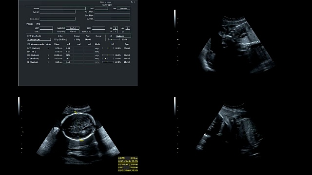 超音波显示25周时同卵双胞胎的心跳视频素材
