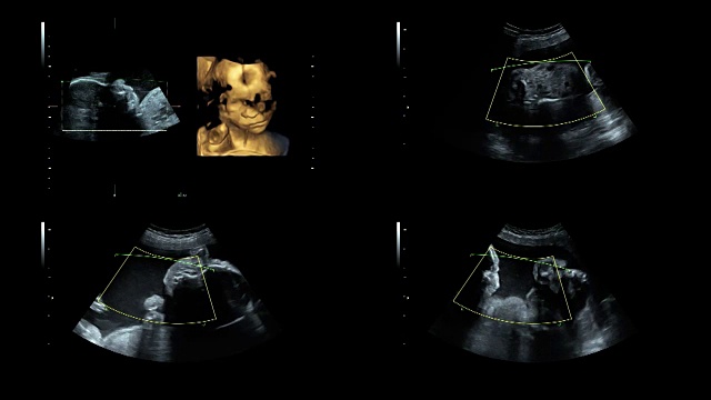 超音波显示25周时同卵双胞胎的心跳视频素材
