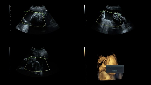 超音波显示25周时同卵双胞胎的心跳视频素材