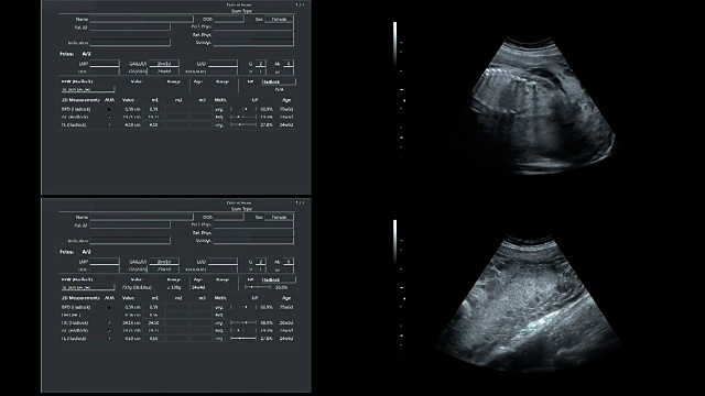 超音波显示25周时同卵双胞胎的心跳视频素材