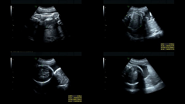 超音波显示同卵双胞胎的心脏在27周时跳动视频素材