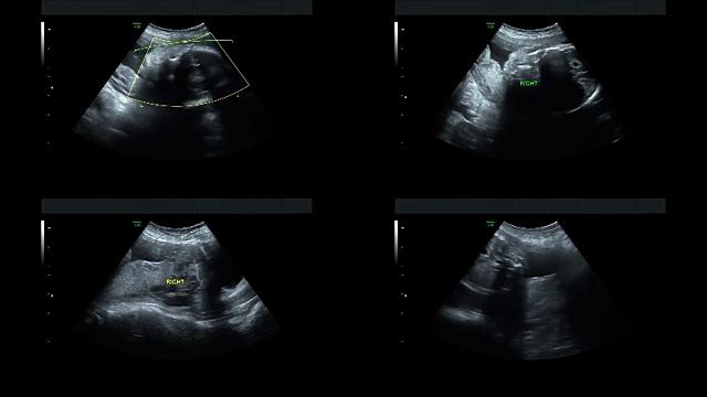 超音波显示同卵双胞胎的心脏在27周时跳动视频素材