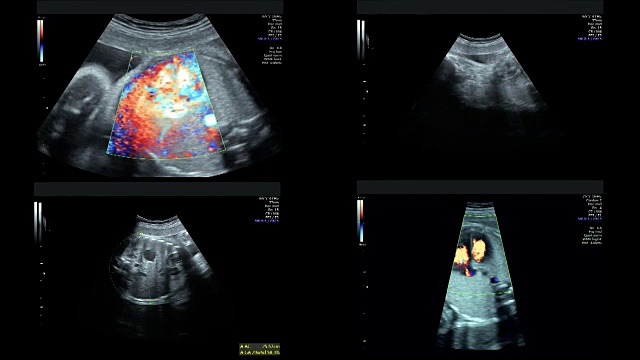孕29周时对同卵双胞胎的超声检查视频素材