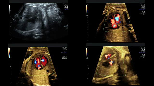 孕29周时对同卵双胞胎的超声检查视频素材