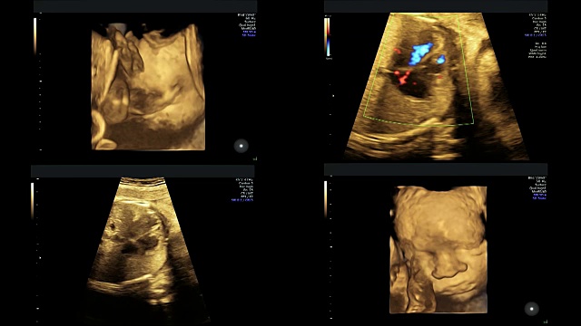 孕29周时对同卵双胞胎的超声检查视频素材