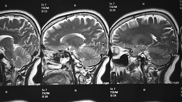 核磁共振视频素材