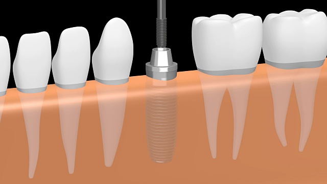 3D种植牙/种植牙视频素材