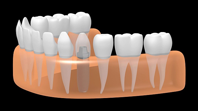 3D种植牙/种植牙视频素材